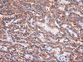 CPA1 / Carboxypeptidase A Antibody - IHC of paraffin-embedded Carcinoma of kidney using anti-CPA1 mouse monoclonal antibody.
