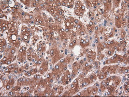 CPA1 / Carboxypeptidase A Antibody - IHC of paraffin-embedded Carcinoma of liver using anti-CPA1 mouse monoclonal antibody.