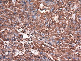 CPA1 / Carboxypeptidase A Antibody - IHC of paraffin-embedded Adenocarcinoma of ovary using anti-CPA1 mouse monoclonal antibody.