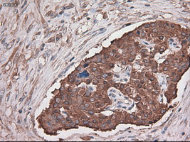 CPA1 / Carboxypeptidase A Antibody - IHC of paraffin-embedded Carcinoma of pancreas using anti-CPA1 mouse monoclonal antibody.