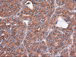 CPA1 / Carboxypeptidase A Antibody - IHC of paraffin-embedded Carcinoma of thyroid using anti-CPA1 mouse monoclonal antibody.