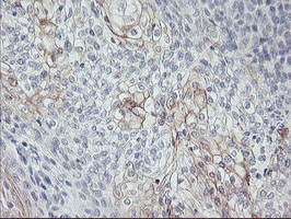 CPA1 / Carboxypeptidase A Antibody - IHC of paraffin-embedded Carcinoma of Human bladder tissue using anti-CPA1 mouse monoclonal antibody.