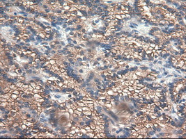 CPA1 / Carboxypeptidase A Antibody - IHC of paraffin-embedded Carcinoma of kidney using anti-CPA1 mouse monoclonal antibody.