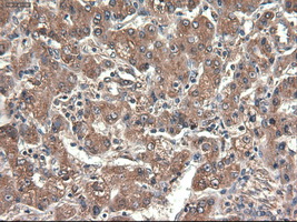 CPA1 / Carboxypeptidase A Antibody - IHC of paraffin-embedded Carcinoma of liver using anti-CPA1 mouse monoclonal antibody.