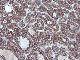 CPA2 Antibody - IHC of paraffin-embedded Carcinoma of Human thyroid tissue using anti-CPA2 mouse monoclonal antibody.