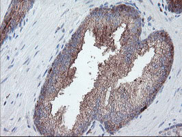 CPA2 Antibody - IHC of paraffin-embedded Carcinoma of Human prostate tissue using anti-CPA2 mouse monoclonal antibody.