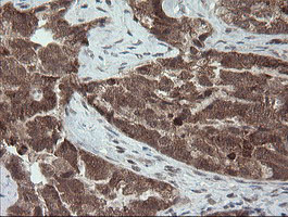 CPA2 Antibody - IHC of paraffin-embedded Adenocarcinoma of Human ovary tissue using anti-CPA2 mouse monoclonal antibody.