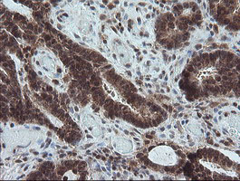 CPA2 Antibody - IHC of paraffin-embedded Adenocarcinoma of Human colon tissue using anti-CPA2 mouse monoclonal antibody.