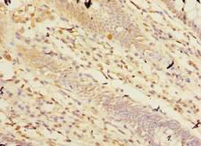 CPA2 Antibody - Immunohistochemistry of paraffin-embedded human colon cancer using antibody at dilution of 1:100.