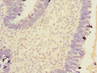 CPA2 Antibody - Immunohistochemistry of paraffin-embedded human ovarian cancer using antibody at dilution of 1:100.