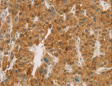 CPA2 Antibody - Immunohistochemistry of paraffin-embedded Human liver cancer using CPA2 Polyclonal Antibody at dilution of 1:20.