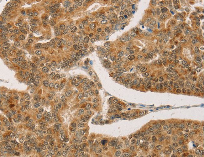 CPA2 Antibody - Immunohistochemistry of paraffin-embedded Human breast cancer using CPA2 Polyclonal Antibody at dilution of 1:20.