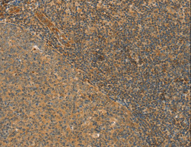 CPA2 Antibody - Immunohistochemistry of paraffin-embedded Human gastric cancer using CPA2 Polyclonal Antibody at dilution of 1:40.