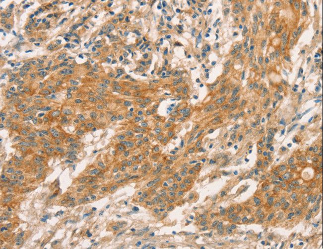CPA2 Antibody - Immunohistochemistry of paraffin-embedded Human gastric cancer using CPA2 Polyclonal Antibody at dilution of 1:40.