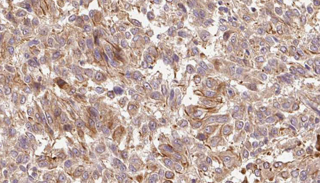 CPA6 / Carboxypeptidase A6 Antibody - 1:100 staining human Melanoma tissue by IHC-P. The sample was formaldehyde fixed and a heat mediated antigen retrieval step in citrate buffer was performed. The sample was then blocked and incubated with the antibody for 1.5 hours at 22°C. An HRP conjugated goat anti-rabbit antibody was used as the secondary.
