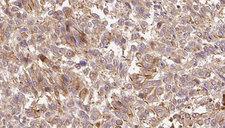 CPA6 / Carboxypeptidase A6 Antibody - 1:100 staining human Melanoma tissue by IHC-P. The sample was formaldehyde fixed and a heat mediated antigen retrieval step in citrate buffer was performed. The sample was then blocked and incubated with the antibody for 1.5 hours at 22°C. An HRP conjugated goat anti-rabbit antibody was used as the secondary.