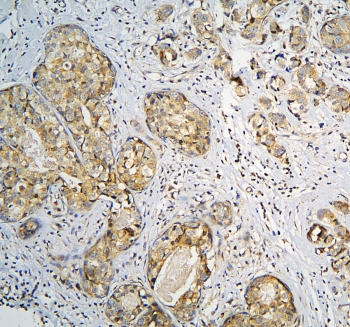 CPAMD8 / KIAA1283 Antibody - IHC staining of FFPE human breast cancer with CPAMD8 antibody at 1ug/ml. HIER: boil tissue sections in pH6, 10mM citrate buffer, for 10-20 min and allow to cool before testing.