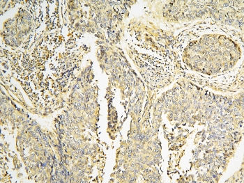 CPAMD8 / KIAA1283 Antibody - IHC staining of FFPE human lung cancer with CPAMD8 antibody at 1ug/ml. HIER: boil tissue sections in pH6, 10mM citrate buffer, for 10-20 min and allow to cool before testing.
