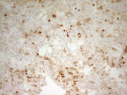 CPB2 / TAFI Antibody - Immunohistochemical staining of paraffin-embedded Carcinoma of Human lung tissue using anti-CPB2 mouse monoclonal antibody. (Heat-induced epitope retrieval by 1 mM EDTA in 10mM Tris, pH8.5, 120C for 3min,