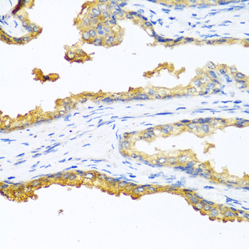 CPB2 / TAFI Antibody - Immunohistochemistry of paraffin-embedded human prostate cancer using CPB2 antibody at dilution of 1:100 (40x lens).