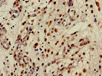 CPB2 / TAFI Antibody - Immunohistochemistry of paraffin-embedded human lung cancer at dilution of 1:100