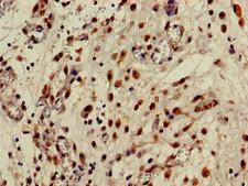 CPB2 / TAFI Antibody - Immunohistochemistry of paraffin-embedded human lung cancer at dilution of 1:100