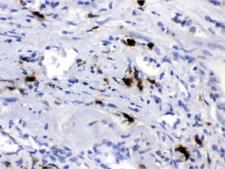 CPB2 / TAFI Antibody - IHC testing of FFPE human lung cancer tissue with Carboxypeptidase B2 antibody at 1ug/ml. HIER: steam in pH6 citrate buffer and allow to cool prior to staining.