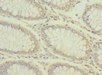 CPD Antibody - Immunohistochemistry of paraffin-embedded human colon cancer at dilution 1:100