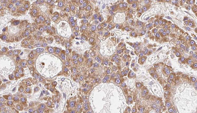 CPD Antibody - 1:100 staining human liver carcinoma tissues by IHC-P. The sample was formaldehyde fixed and a heat mediated antigen retrieval step in citrate buffer was performed. The sample was then blocked and incubated with the antibody for 1.5 hours at 22°C. An HRP conjugated goat anti-rabbit antibody was used as the secondary.