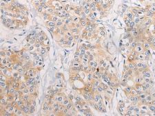 CPD Antibody - Immunohistochemistry of paraffin-embedded Human prost at e cancer tissue  using CPD Polyclonal Antibody at dilution of 1:70(×200)