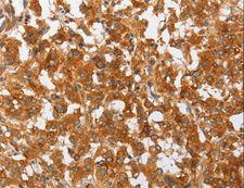 cPLA2 Antibody - Immunohistochemistry of paraffin-embedded Human thyroid cancer using PLA2G4A Polyclonal Antibody at dilution of 1:50.