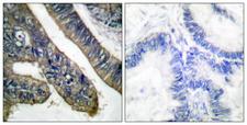 cPLA2 Antibody - Immunohistochemistry analysis of paraffin-embedded human colon carcinoma, using c-PLA2 (Phospho-Ser505) Antibody. The picture on the right is blocked with the phospho peptide.