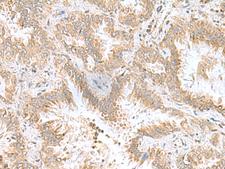 CPLX3 Antibody - Immunohistochemistry of paraffin-embedded Human lung cancer tissue  using CPLX3 Polyclonal Antibody at dilution of 1:55(×200)