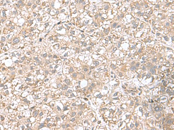 CPLX3 Antibody - Immunohistochemistry of paraffin-embedded Human liver cancer tissue  using CPLX3 Polyclonal Antibody at dilution of 1:65(×200)