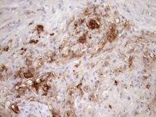 CPM / Carboxypeptidase M Antibody - Immunohistochemical staining of paraffin-embedded Carcinoma of Human lung tissue using anti-CPM mouse monoclonal antibody. (Heat-induced epitope retrieval by Tris-EDTA, pH8.0)(1:150)