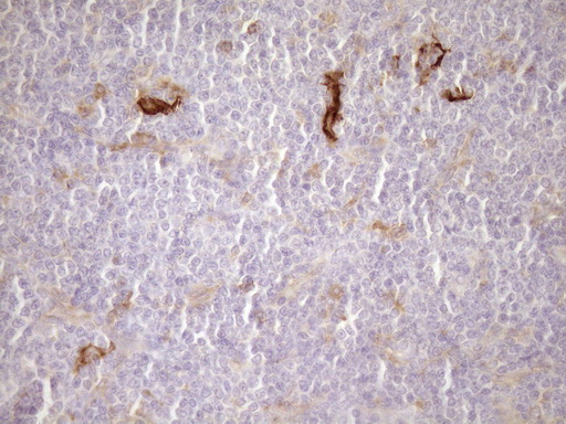 CPM / Carboxypeptidase M Antibody - Immunohistochemical staining of paraffin-embedded Human lymphoma tissue using anti-CPM mouse monoclonal antibody. (Heat-induced epitope retrieval by Tris-EDTA, pH8.0)(1:150)