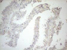 CPM / Carboxypeptidase M Antibody - Immunohistochemical staining of paraffin-embedded Adenocarcinoma of Human ovary tissue using anti-CPM mouse monoclonal antibody. (Heat-induced epitope retrieval by 1mM EDTA in 10mM Tris buffer. (pH8.5) at 120°C for 3 min. (1:150)