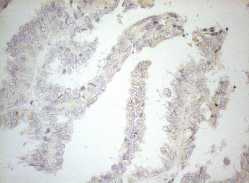 CPM / Carboxypeptidase M Antibody - Immunohistochemical staining of paraffin-embedded Adenocarcinoma of Human ovary tissue using anti-CPM mouse monoclonal antibody. (Heat-induced epitope retrieval by 1mM EDTA in 10mM Tris buffer. (pH8.5) at 120°C for 3 min. (1:150)
