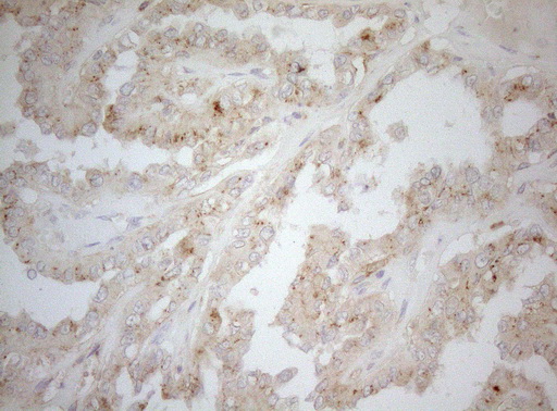 CPM / Carboxypeptidase M Antibody - Immunohistochemical staining of paraffin-embedded Carcinoma of Human thyroid tissue using anti-CPM mouse monoclonal antibody. (Heat-induced epitope retrieval by 1mM EDTA in 10mM Tris buffer. (pH8.5) at 120°C for 3 min. (1:150)