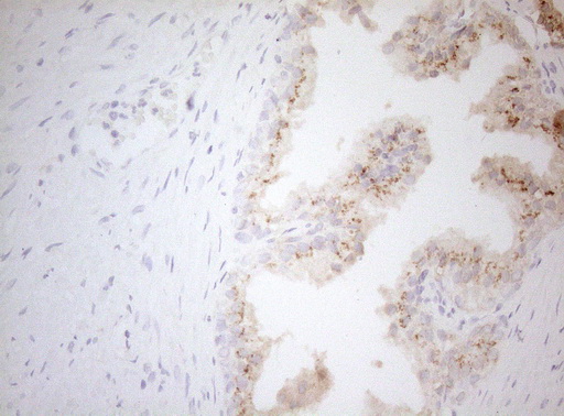 CPM / Carboxypeptidase M Antibody - Immunohistochemical staining of paraffin-embedded Human prostate tissue within the normal limits using anti-CPM mouse monoclonal antibody. (Heat-induced epitope retrieval by 1mM EDTA in 10mM Tris buffer. (pH8.5) at 120°C for 3 min. (1:150)