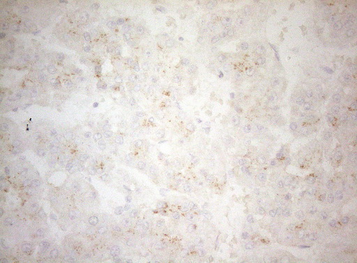 CPM / Carboxypeptidase M Antibody - Immunohistochemical staining of paraffin-embedded Carcinoma of Human liver tissue using anti-CPM mouse monoclonal antibody. (Heat-induced epitope retrieval by 1mM EDTA in 10mM Tris buffer. (pH8.5) at 120°C for 3 min. (1:150)
