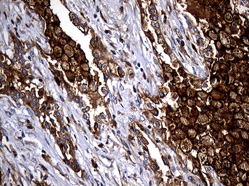 CPM / Carboxypeptidase M Antibody - Immunohistochemical staining of paraffin-embedded Carcinoma of Human lung tissue using anti-CPM mouse monoclonal antibody. (Heat-induced epitope retrieval by 1mM EDTA in 10mM Tris buffer. (pH8.5) at 120°C for 3 min. (1:2000)
