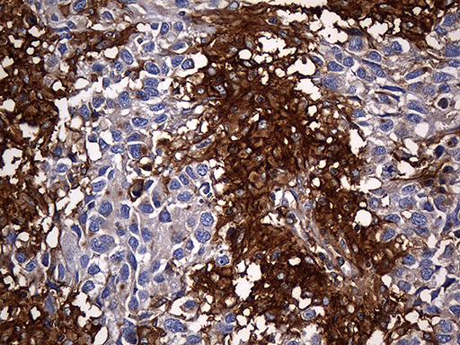 CPM / Carboxypeptidase M Antibody - Immunohistochemical staining of paraffin-embedded Adenocarcinoma of Human ovary tissue using anti-CPM mouse monoclonal antibody. (Heat-induced epitope retrieval by 1mM EDTA in 10mM Tris buffer. (pH8.5) at 120°C for 3 min. (1:2000)
