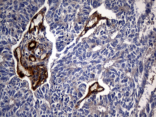 CPM / Carboxypeptidase M Antibody - Immunohistochemical staining of paraffin-embedded Adenocarcinoma of Human endometrium tissue using anti-CPM mouse monoclonal antibody. (Heat-induced epitope retrieval by 1mM EDTA in 10mM Tris buffer. (pH8.5) at 120°C for 3 min. (1:2000)