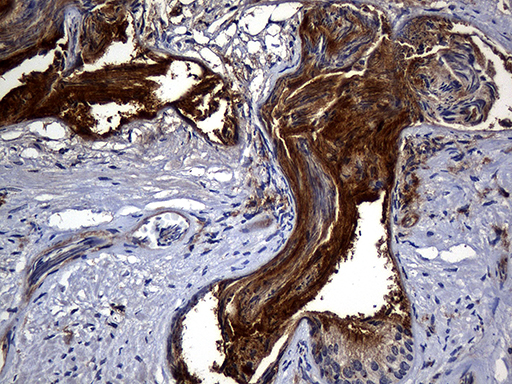 CPM / Carboxypeptidase M Antibody - Immunohistochemical staining of paraffin-embedded Human prostate tissue within the normal limits using anti-CPM mouse monoclonal antibody. (Heat-induced epitope retrieval by 1mM EDTA in 10mM Tris buffer. (pH8.5) at 120°C for 3 min. (1:2000)
