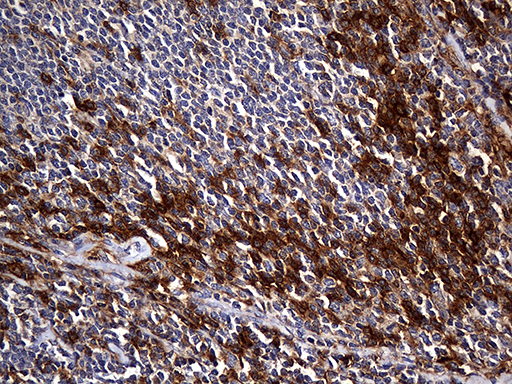 CPM / Carboxypeptidase M Antibody - Immunohistochemical staining of paraffin-embedded Human lymphoma tissue using anti-CPM mouse monoclonal antibody. (Heat-induced epitope retrieval by 1mM EDTA in 10mM Tris buffer. (pH8.5) at 120°C for 3 min. (1:2000)