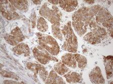 CPM / Carboxypeptidase M Antibody - Immunohistochemical staining of paraffin-embedded Carcinoma of Human liver tissue using anti-CPM mouse monoclonal antibody. (Heat-induced epitope retrieval by 1mM EDTA in 10mM Tris buffer. (pH8.5) at 120 oC for 3 min. (1:150)