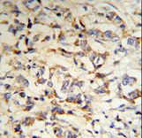 CPN2 Antibody - CPN2 Antibody (RB18703) IHC of formalin-fixed and paraffin-embedded human breast carcinoma tissue followed by peroxidase-conjugated secondary antibody and DAB staining.