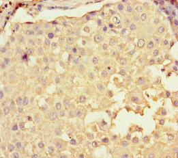 CPNE2 Antibody - Immunohistochemistry of paraffin-embedded human breast cancer using CPNE2 Antibody at dilution of 1:100