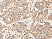 CPNE3 Antibody - Immunohistochemistry of paraffin-embedded Human liver cancer tissue  using CPNE3 Polyclonal Antibody at dilution of 1:40(×200)